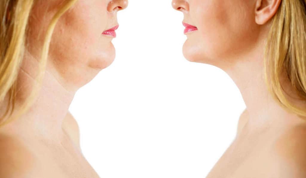 Double Chin treatment Warwickshire before and after results