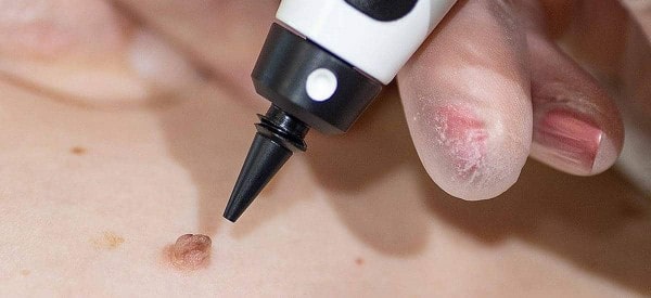 After Skin Tag Removal Warwickshire