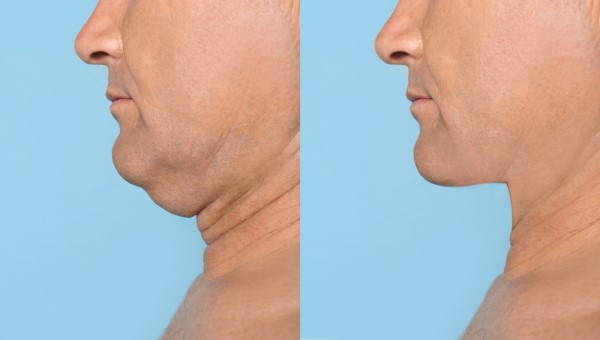 Which Non-Surgical Treatments Work Best for Jowls and Loose Skin Warwickshire?