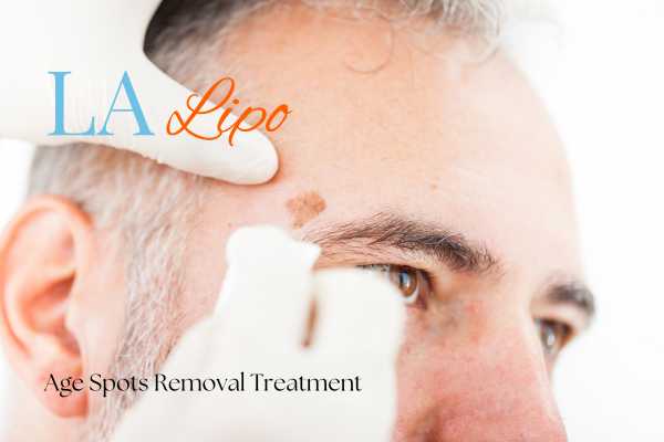 What Are the Most Effective Treatments for Age Spots Warwickshire?