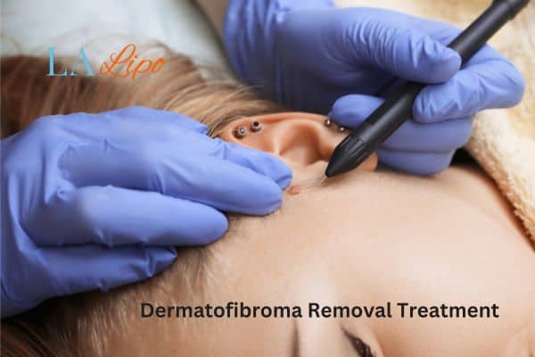 Dermatofibroma Removal Treatment Warwickshire