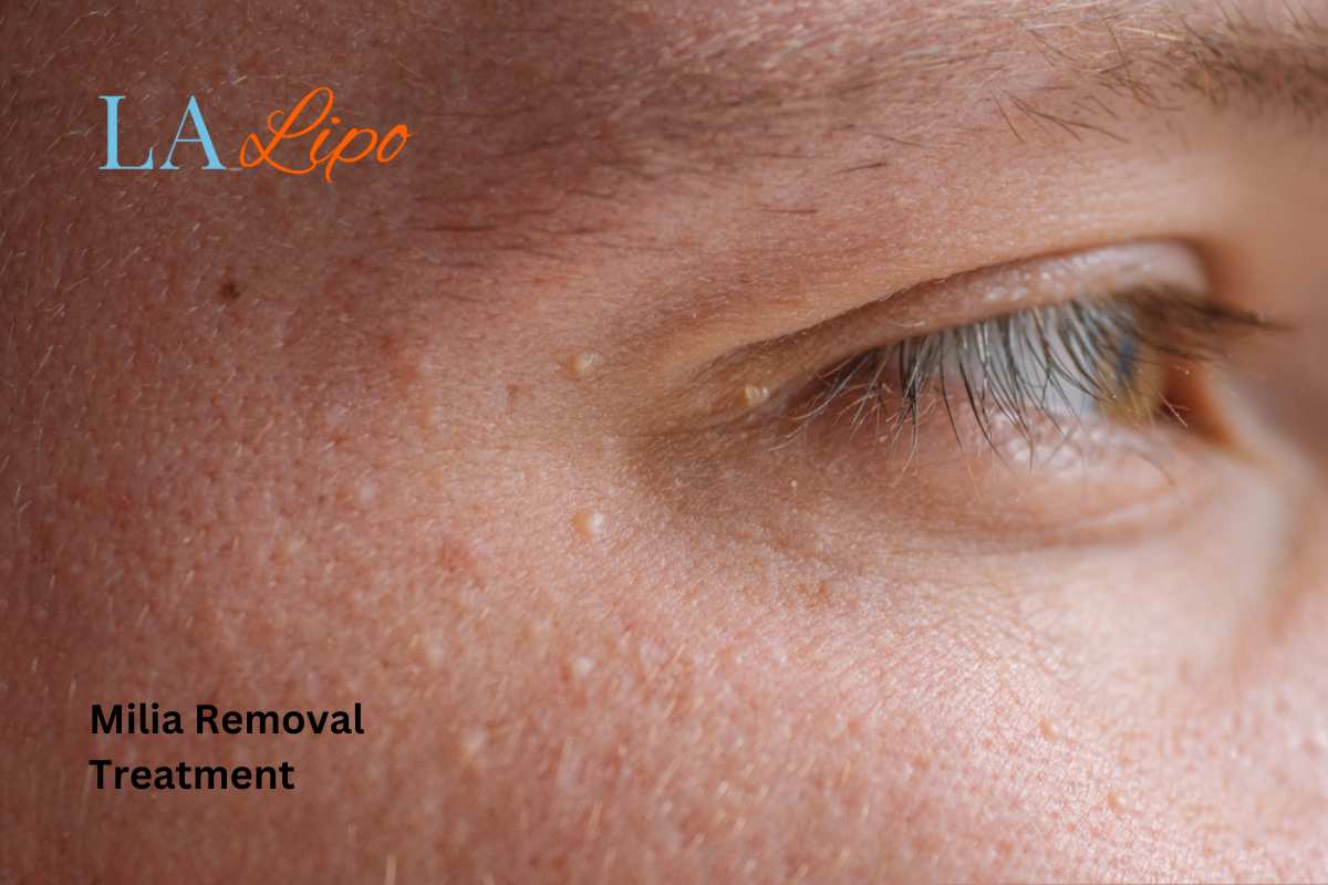 Cryopen Milia Removal: Is It the Easiest and Safest Option Warwickshire?