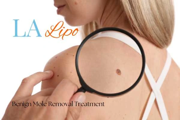 Woman having her inspection of blemish before mole removal Warwickshire