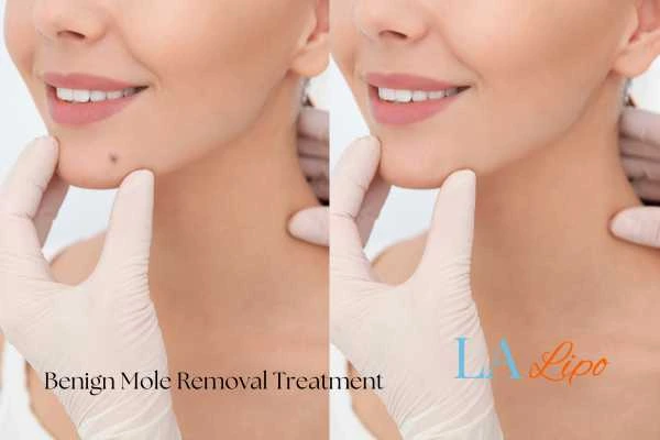 Before and after mole removal Warwickshire treatment