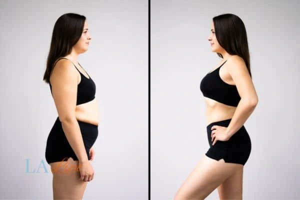 image of woman before and after results of LA-EMS Body Sculpting Warwickshire to help treat Diastasis recti