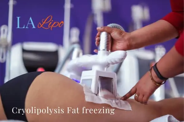 women getting fat freezing Warwickshire