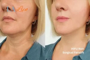 hi-fu for wrinkles Warwickshire before and after results