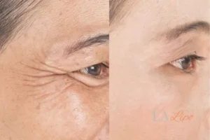Before and after results of woman - HI-fu wrinkles reduction treatment Warwickshire