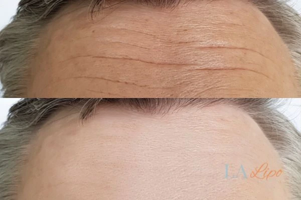results of HIFU Warwickshire on mans forehead to help reduce lines and wrinkles