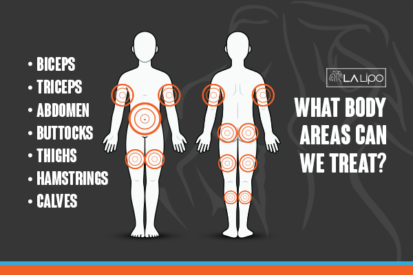 Graphic to show areas you can have LA-EMS Body Sculpting Warwickshire treatment.