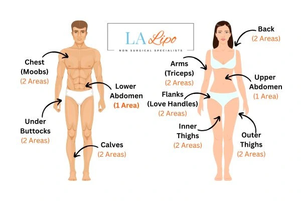 LA LIPO Cryolipolysis Areas Warwickshire