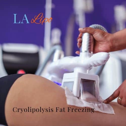 fat freezing - Cryolipolysis Warwickshire
