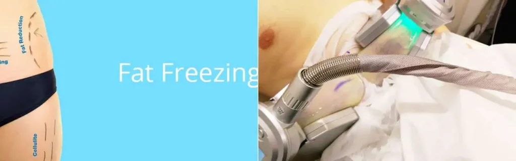multi areas of a persons body having coolsculpting Warwickshire treatment