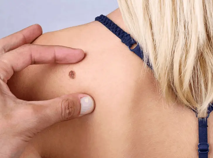 woman having mole removal Warwickshire consultation before treatment.