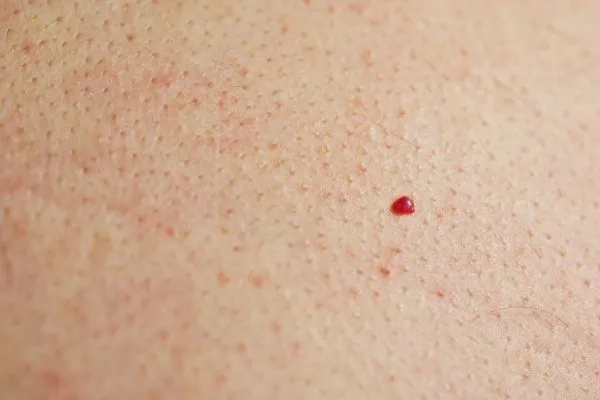 close up of a cherry angioma Warwickshire