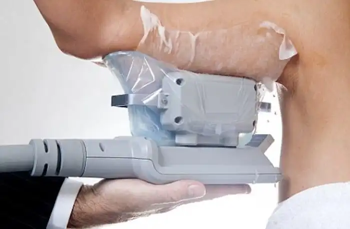 Picture of fat freezing Warwickshire on the upper arms.