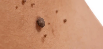 image of a skin tag Warwickshire