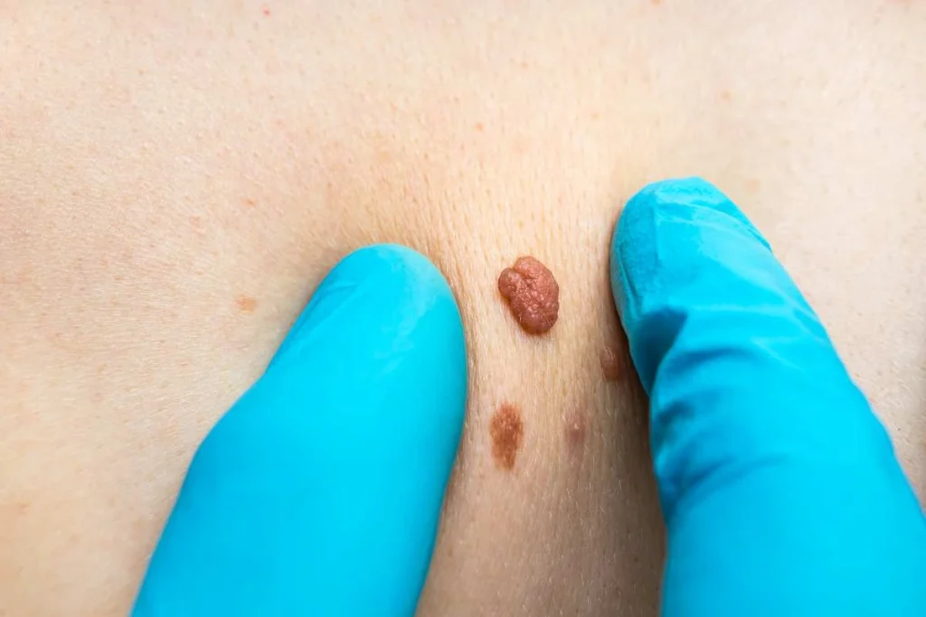 Consultant examining a skin tag Warwickshire