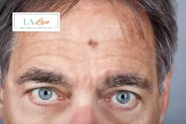 Solar Lentigo Removal Warwickshire image of man with mark on his forehead