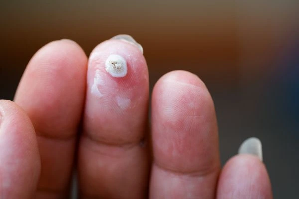 wart on person finger - cryotherapy to treat from LA LIPO Warwickshire