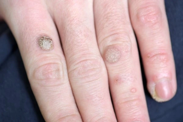 photo of warts on person hand - see wart removal Warwickshire from LA LIPO