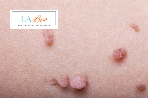 Does cryopen skin tag removal Warwickshire hurt? Find out now call our team today!