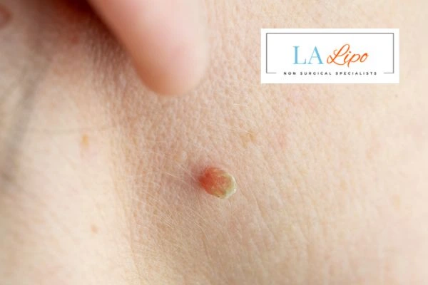 Book skin tag removal Warwickshire today speak to our team now!