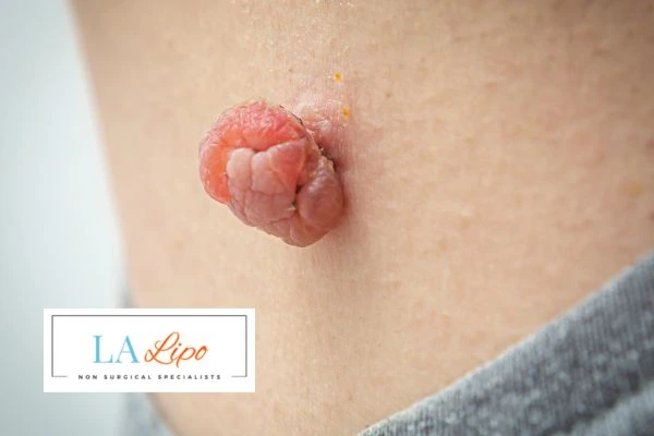 Interested in skin tag removal Warwickshire? Concerned about the pain? Find out more today!