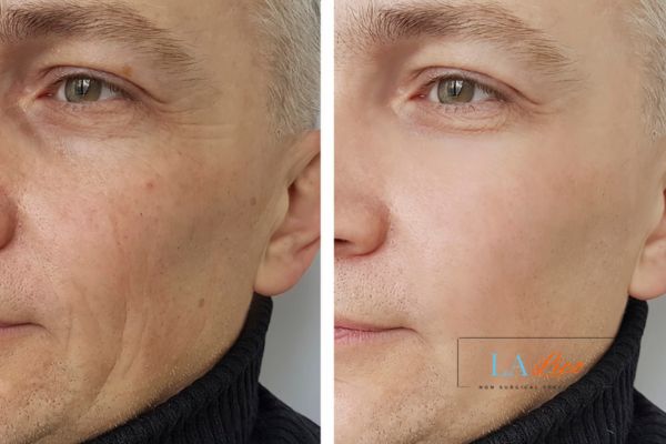 See the amazing results of Morpheus8 Treatment Warwickshire!