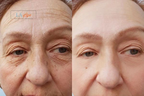The powerful benefits of Morpheus8 Treatment Warwickshire - Call Our team today!