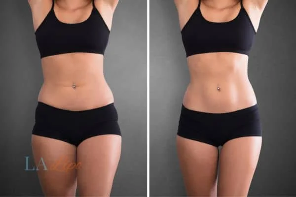before and after results of non-surgical treatment to help a woman's body image and mental health Warwickshire