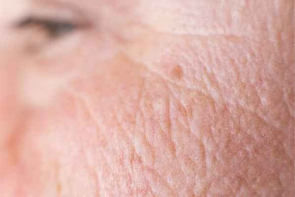 close up picture of a woman's face showing an age spot Warwickshire