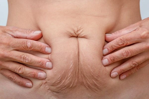 Image of a woman's stomach with loose skin - example of skin tightening Warwickshire options