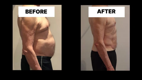 What Symptoms Can Diastasis Recti Cause in Men? Weak Core, Back Pain and Poor Posture Warwickshire